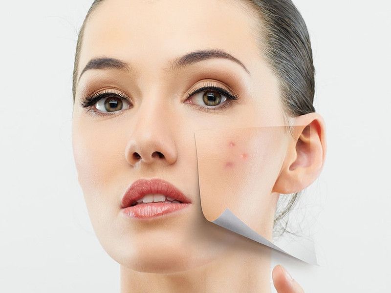Come prendersi cura del proprio viso: i consigli per una pelle acneica